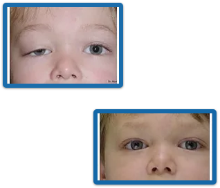 Corrección de Ptosis Palpebral