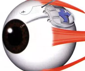 Implantes de Válvulas para Glaucoma