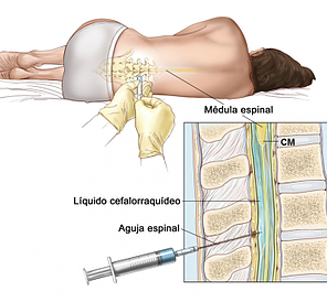 Punción Lumbar