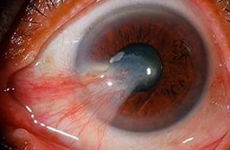 Pterygium