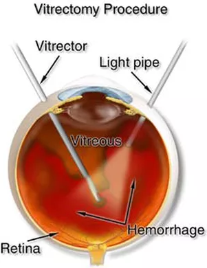 Cirugía de Retina y Vitreo