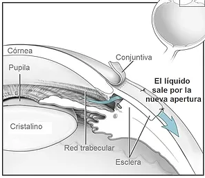 Trabeculectomía